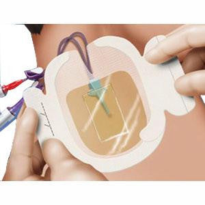 Bx/25 Tegaderm Chg Iv Securement Dressing, Size 8.5Cm X 11.5Cm