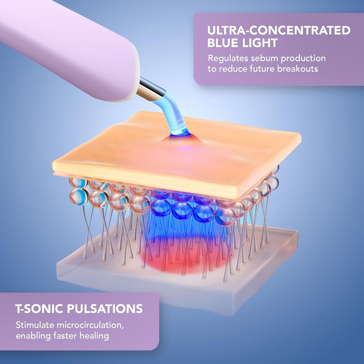 Acne Treatment ESPADA™ 2 plus