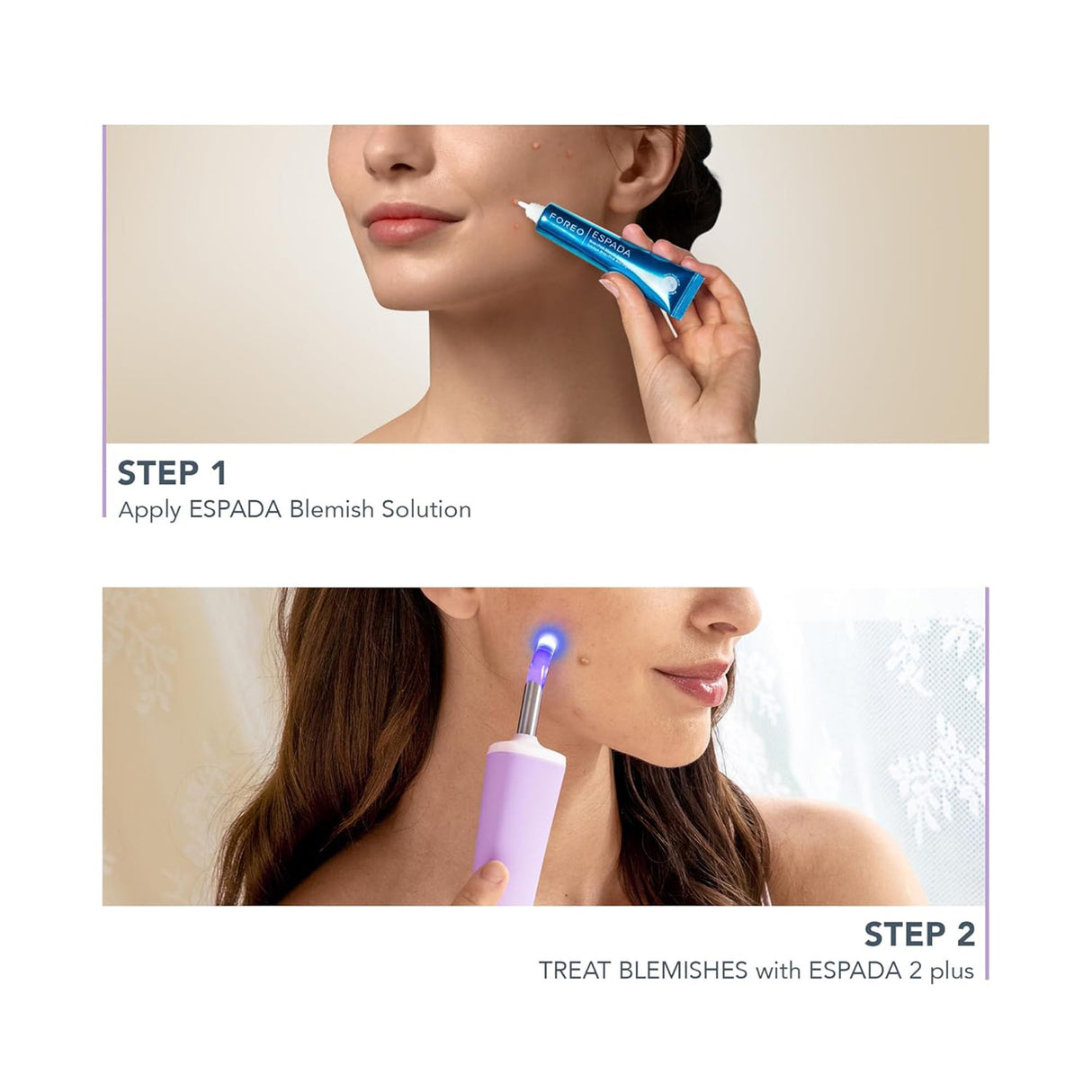 Acne Treatment ESPADA™ 2 plus