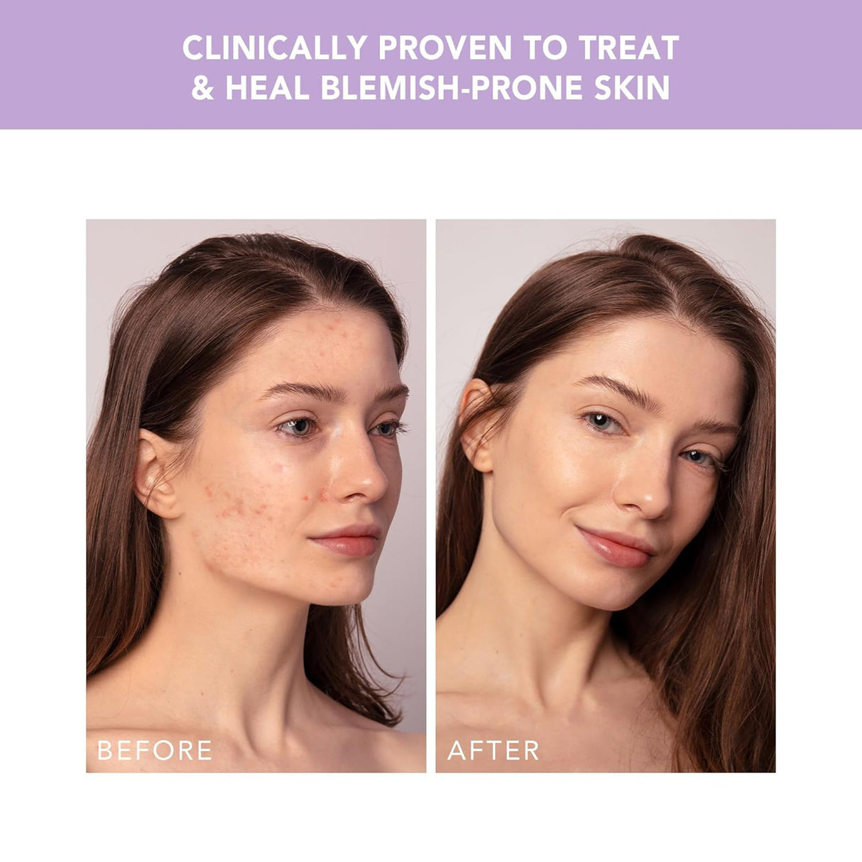 Acne Treatment ESPADA™ 2 plus