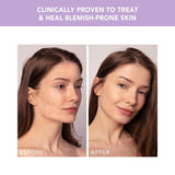 Acne Treatment ESPADA™ 2 plus